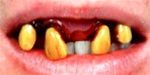Billy Bob Teeth 10071 Jethro Fake Teeth