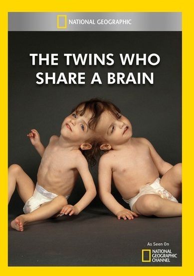 The Twins Who Share a Brain