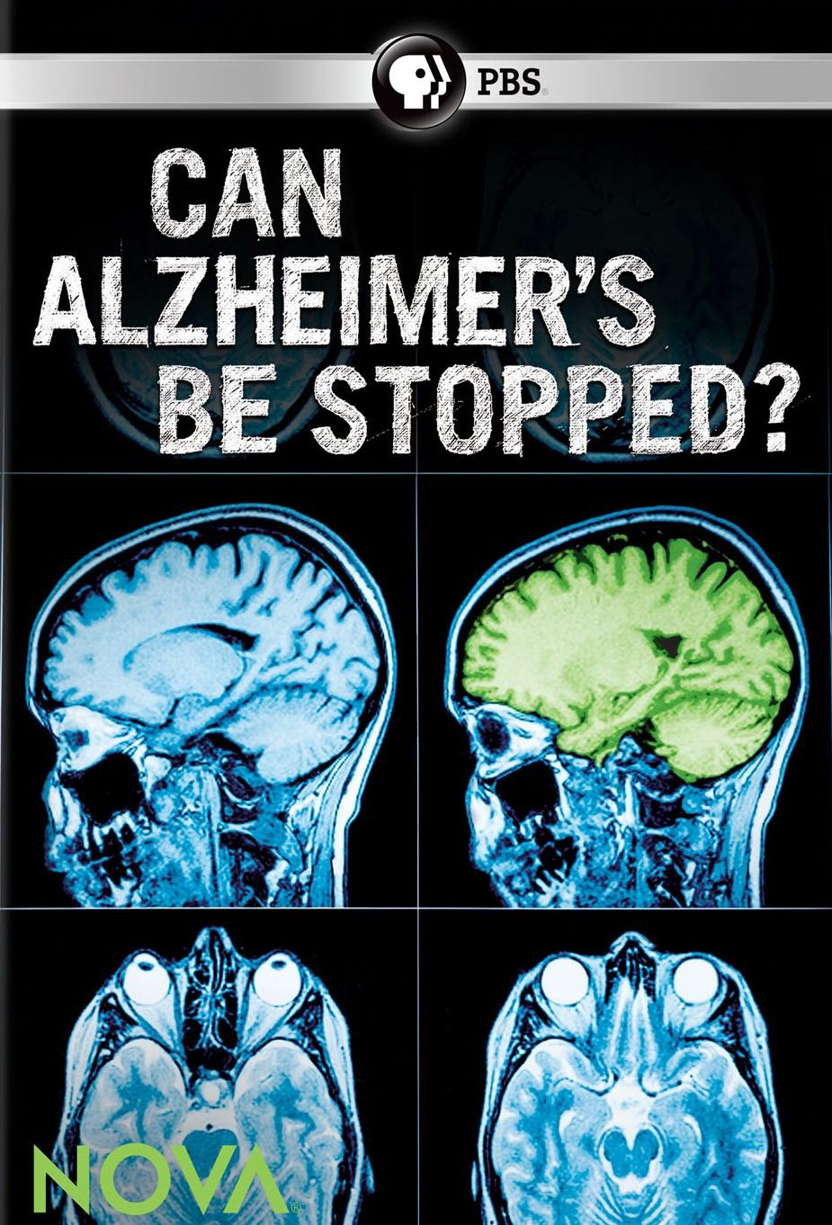 NOVA: Can Alzheimer's Be Stopped?