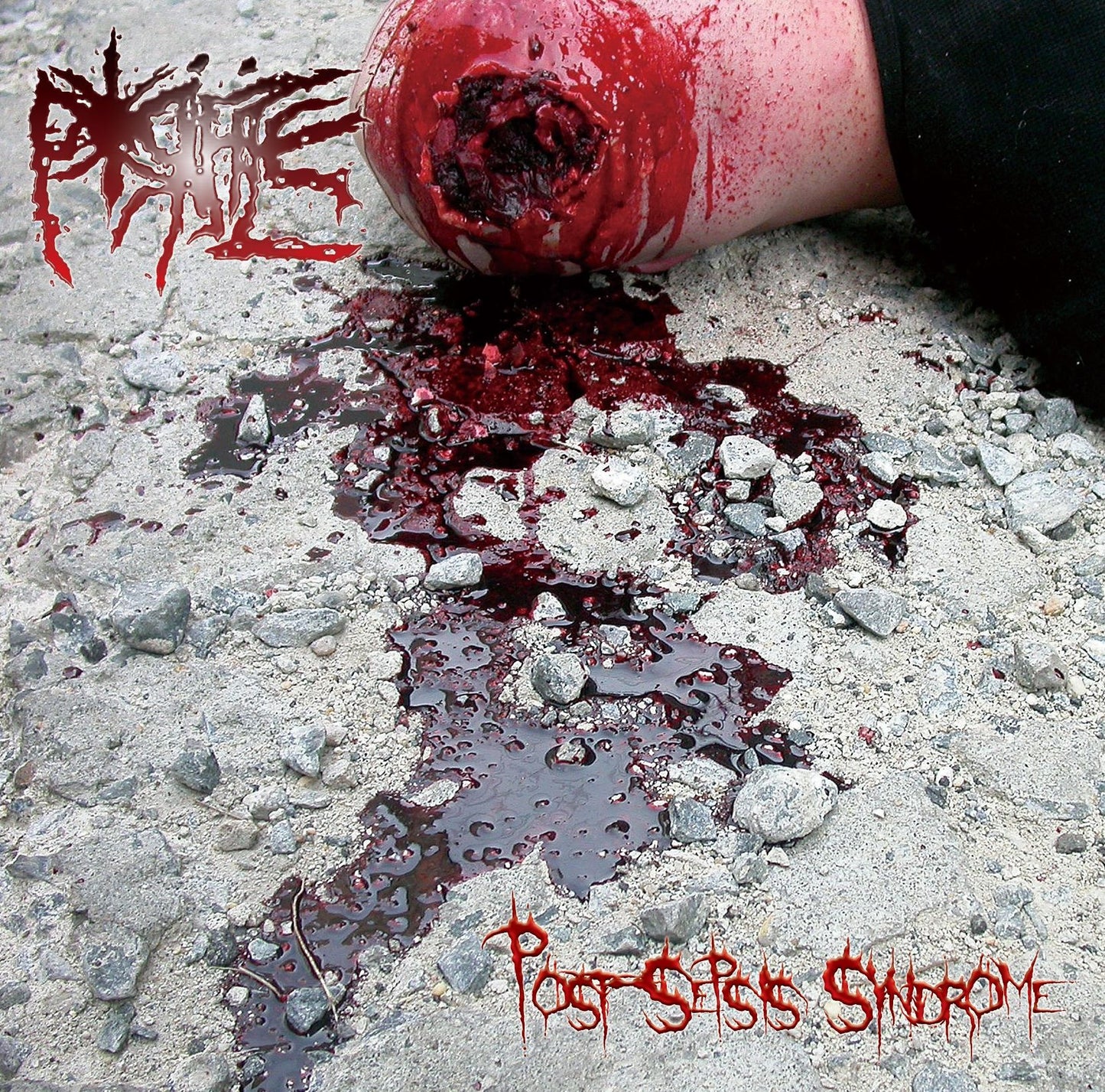 Post-Sepsis Syndrome