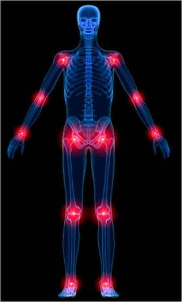 Arthritis: Diagnosis and Treatment Options including Natural Pain Remedies