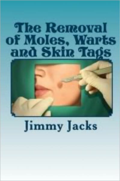 The Removal of Moles, Warts and Skin Tags