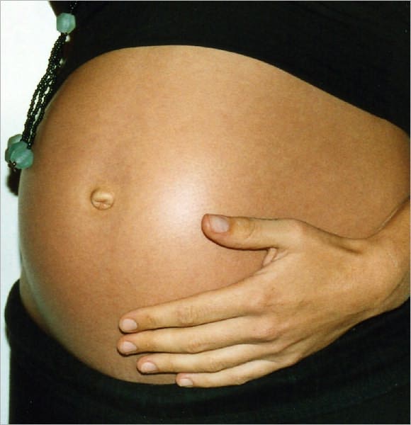 Stretch Marks Get Rid of Them the Natural Way!!