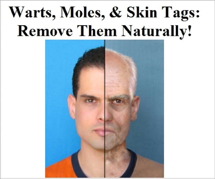 Warts, Moles, & Skin Tags: Remove Them Naturally!