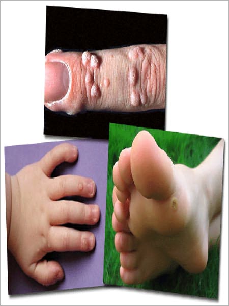 Natural Home Remedies For Wart Removal Solutions