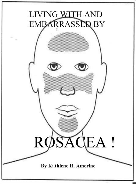 Living With And Embarrassed By Rosacea