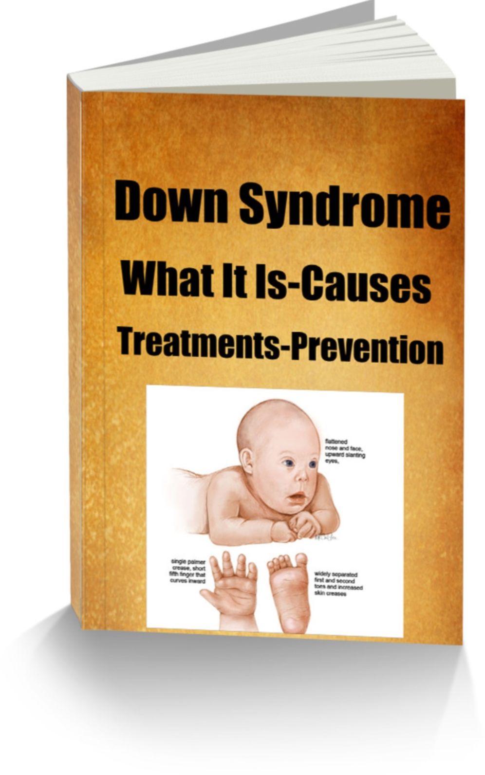 Down Syndrome-What It Is-Causes-Treatments-Prevention
