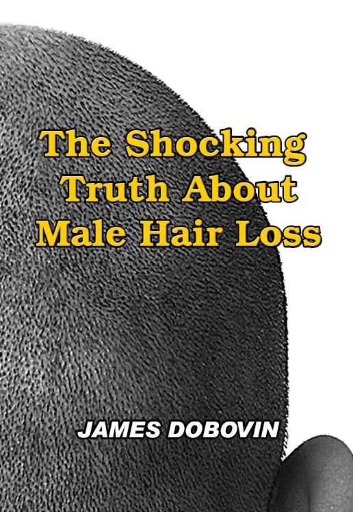 The Shocking Truth About Male Hair Loss