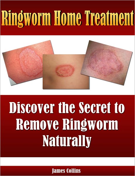 Ringworm Home Treatment: Discover the Secret to Remove Ringworm Naturally