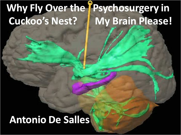 Why Fly Over the Cuckoo's Nest? Psychosurgery in My Brain Please!