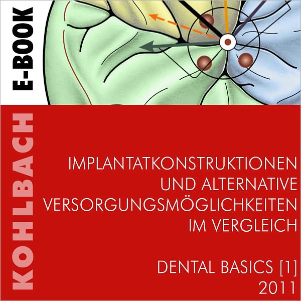 Implantatkonstruktionen und alternative Versorgungsm&ouml;glichkeiten im Vergleich Basics 1 (German Edition)
