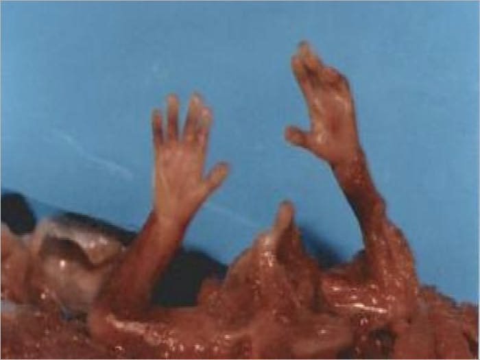 Injecting Aborted Fetus Material into Children
