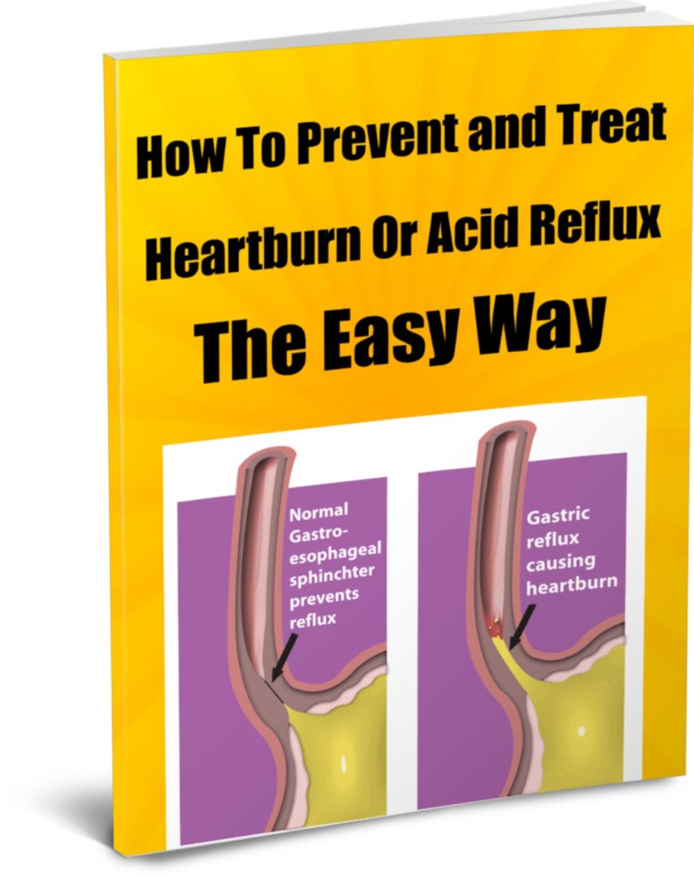 How To Prevent and Treat Heartburn or Acid Reflux The Easy Way
