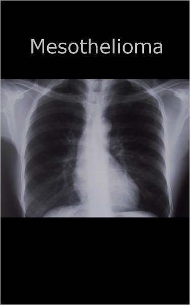An In Depth Guide To Mesothelioma Symptoms, Prevention and Treatment