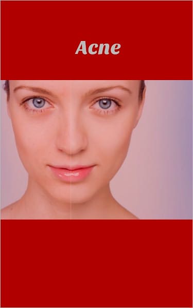 Know The Best Acne Solution For You
