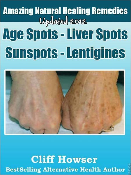 Amazing Natural Healing Remedies - Age Spots - Liver Spots - Sunspots - Lentigines