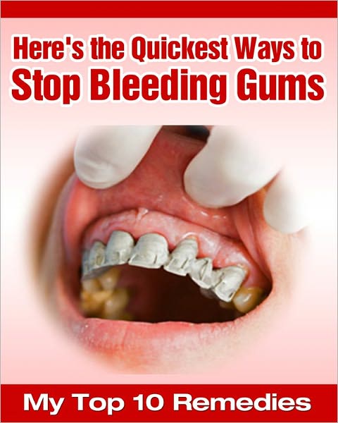 Here's the Quickest Ways to Stop Bleeding Gums - My Top 10 Remedies