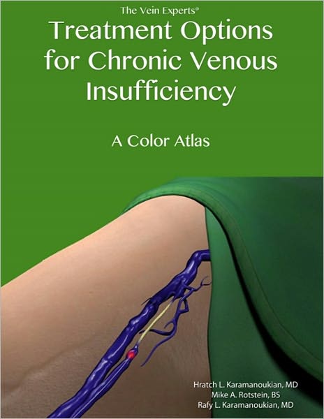 Treatment Options for Chronic Venous Insufficiency