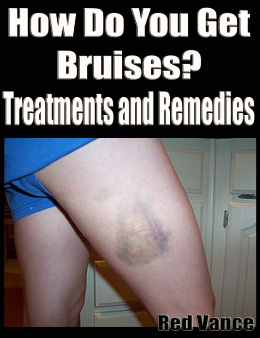 How Do You Get Bruises? Treatments and Remedies