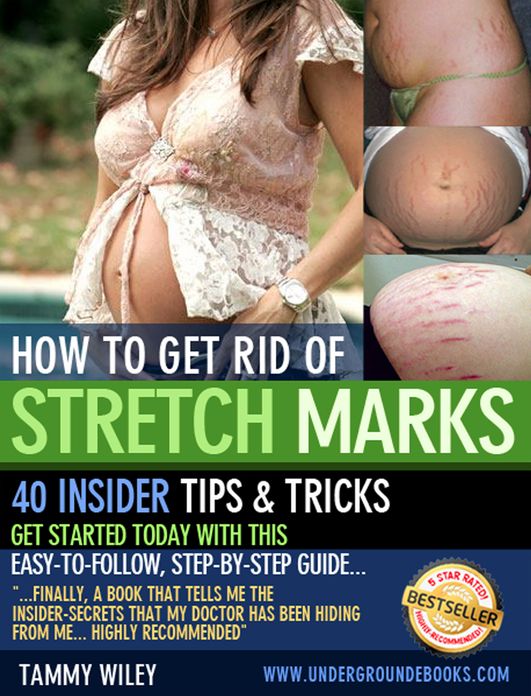 How to Get Rid of Stretch Marks