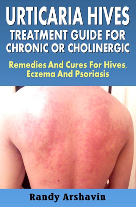 Urticaria Hives : Treatment Guide For Chronic Or Cholinergic : Remedies And Cures For Hives, Eczema And Psoriasis