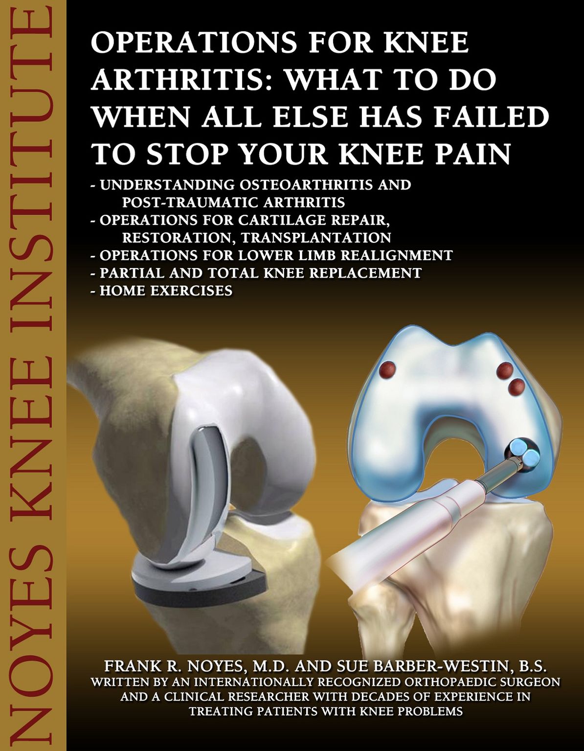 Operations for Knee Arthritis: What To Do When All Else Has Failed To Stop Your Knee Pain