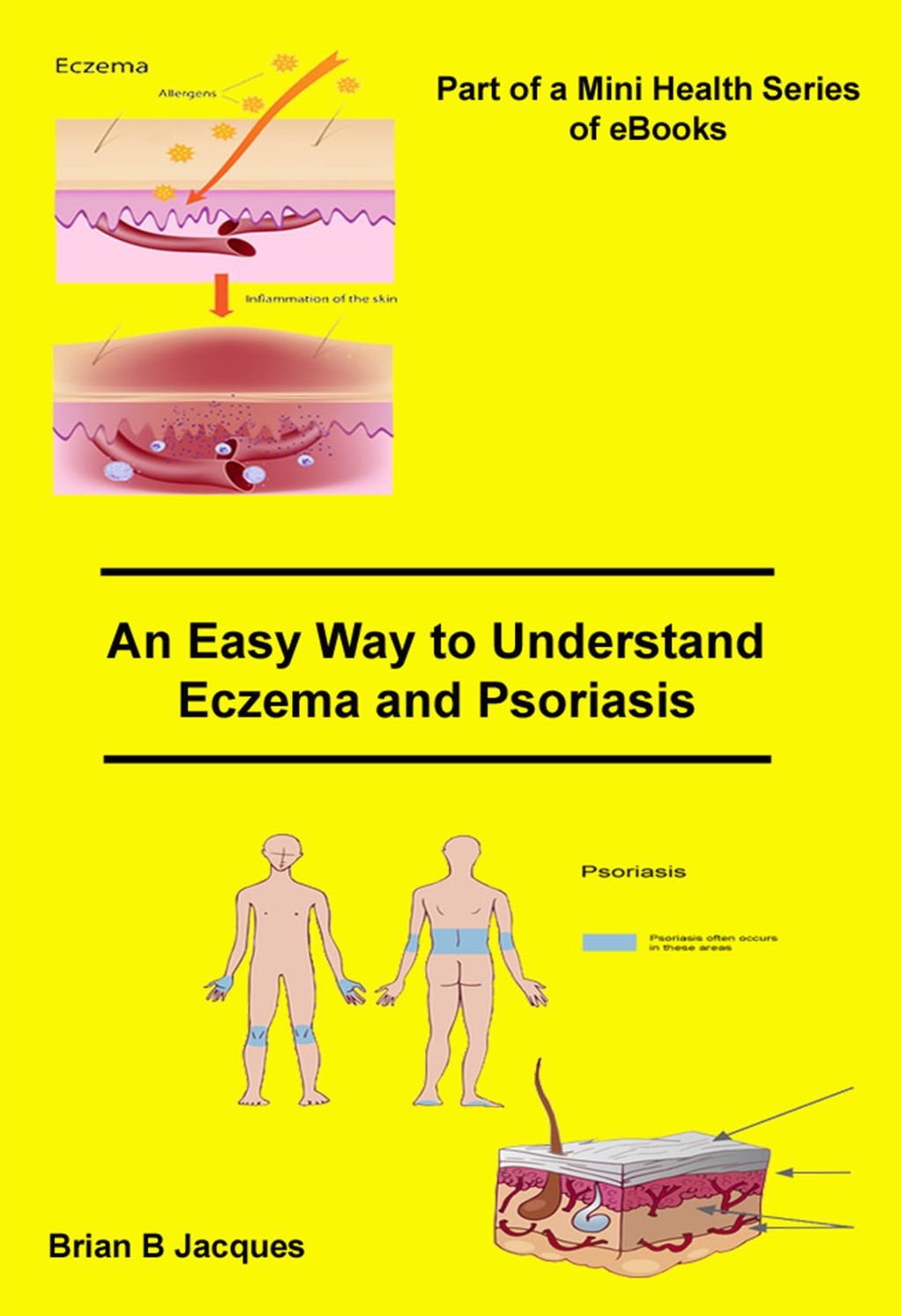 An Easy Way To Understand Eczema and Psoriasis