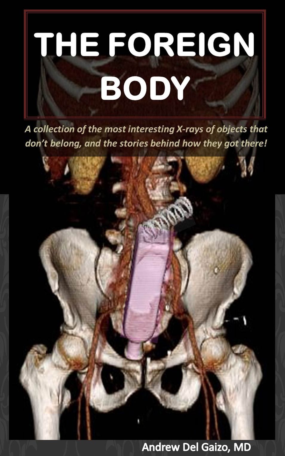 The Foreign Body: A collection of the most interesting X-rays of things that dont belong and the stories behind how they got there!