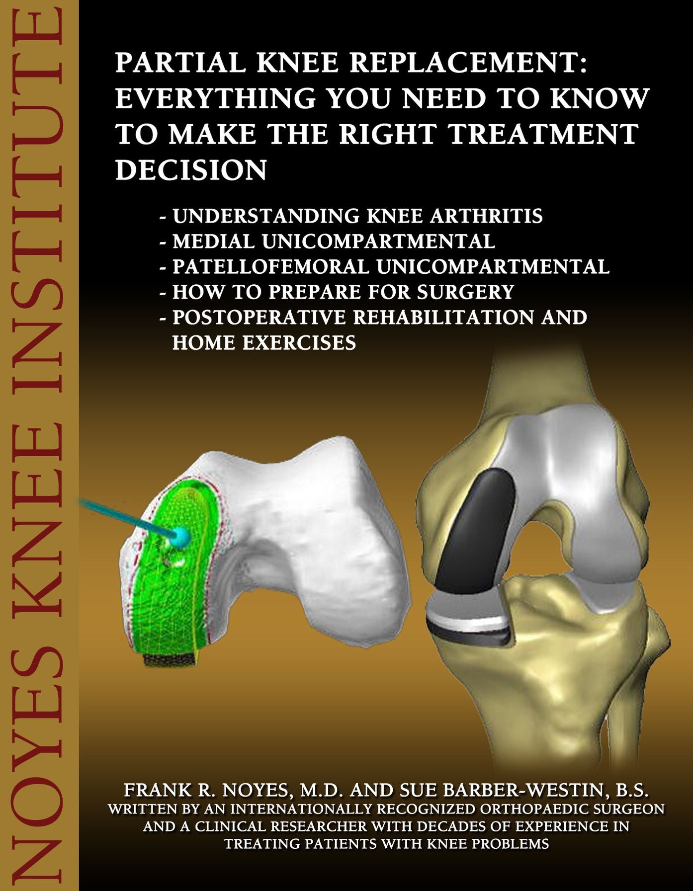 Partial Knee Replacement: Everything You Need to Know to Make the Right Treatment Decision: Understanding knee arthritis - Medial unicompartmental - Patellofemoral unicompartmental - How to prepare fo