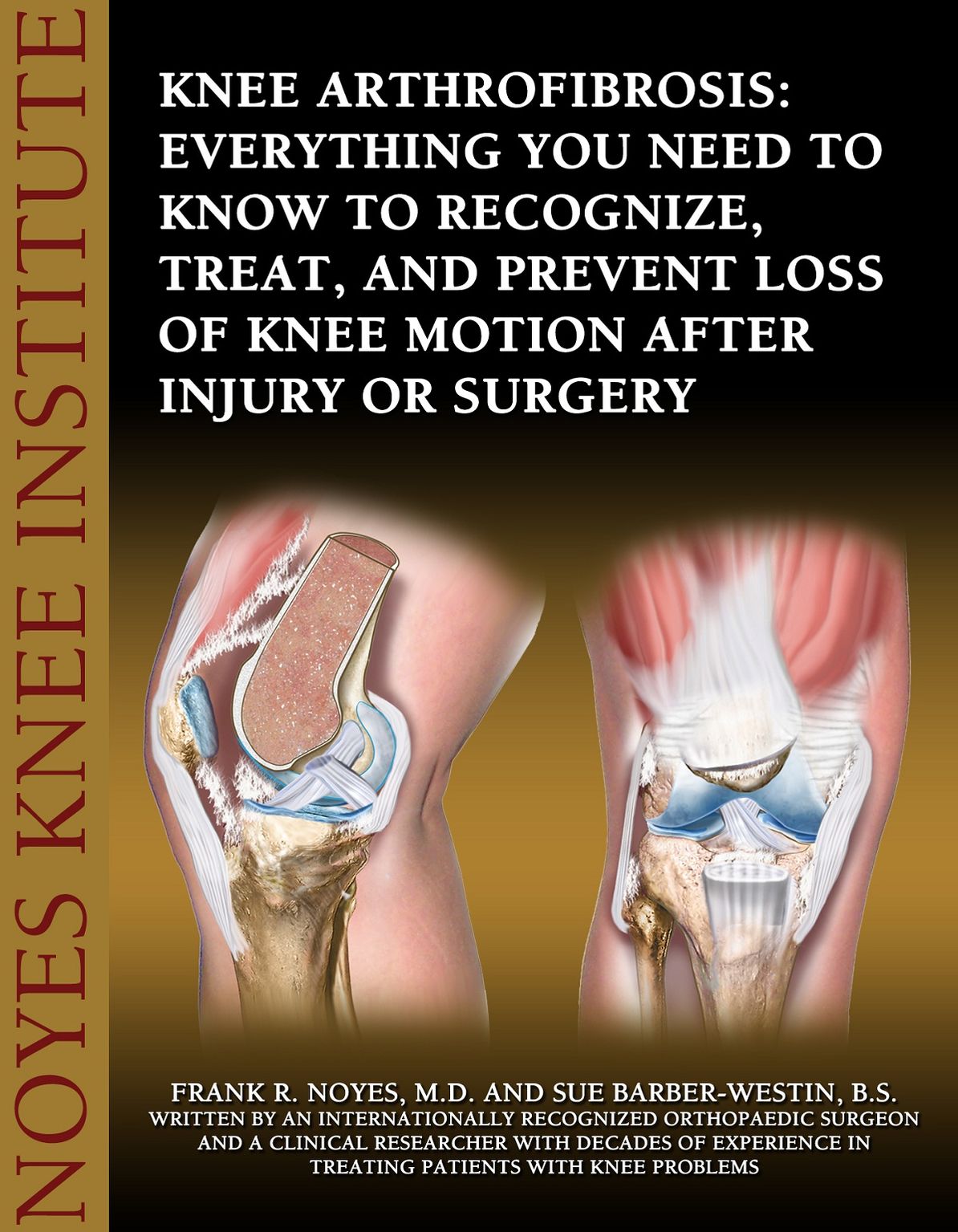 Knee Arthrofibrosis: Everything You Need to Know to Recognize, Treat, and Prevent Loss of Knee Motion After Injury or Surgery