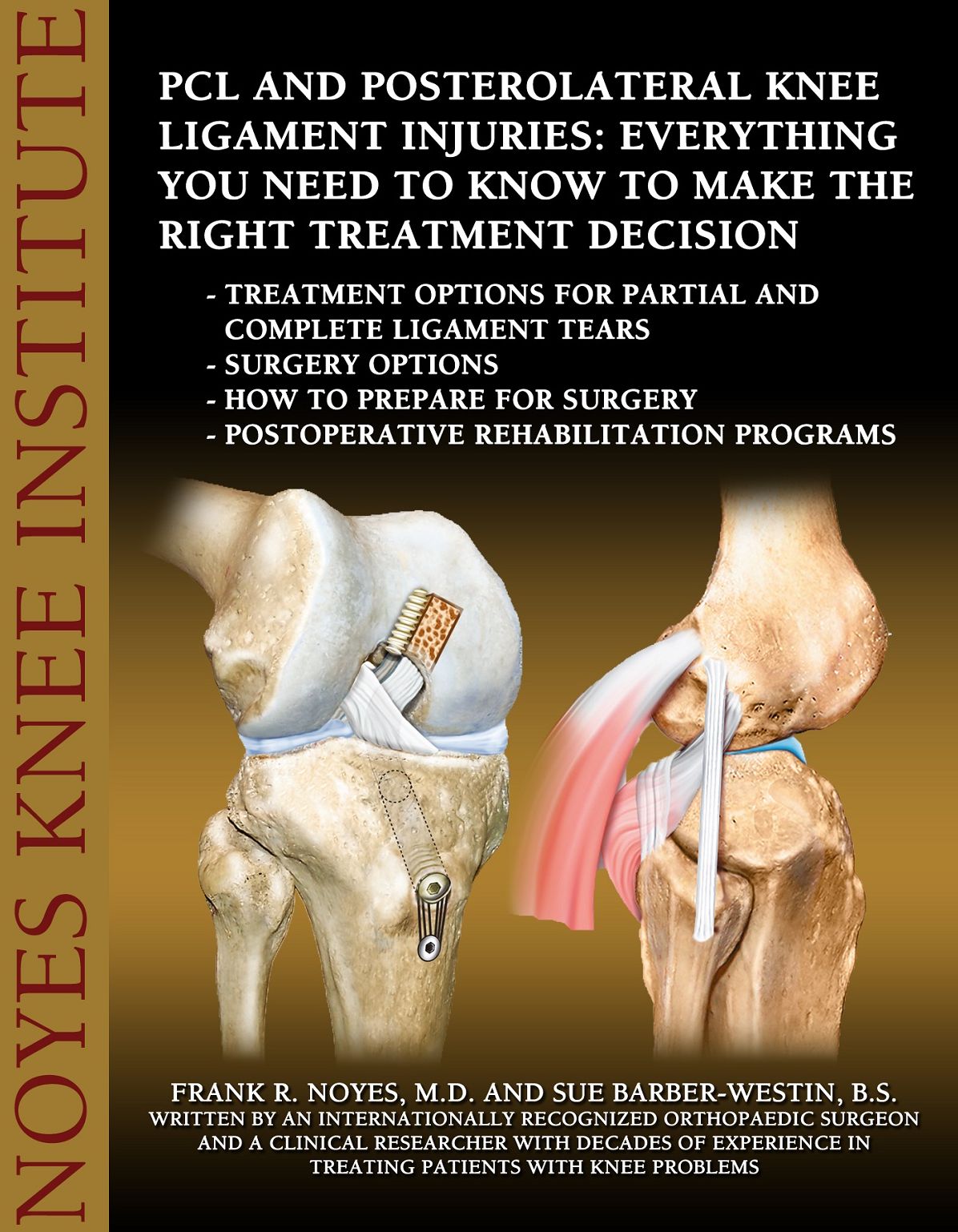 PCL and Posterolateral Knee Ligament Injuries: Everything You Need to Know to Make the Right Treatment Decision: Treatment options for partial and complete ligament tears - Surgery options-How to pre
