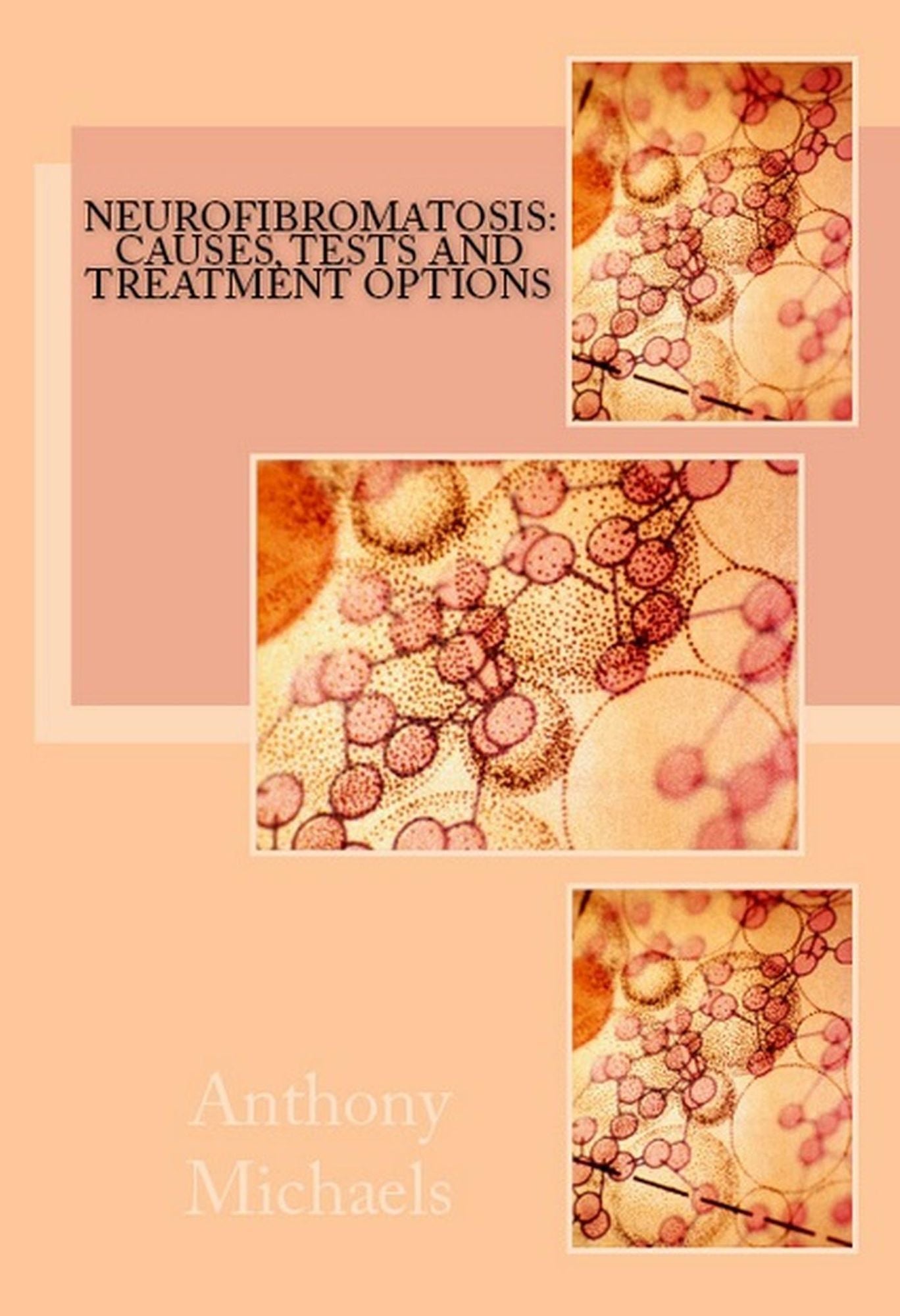 Neurofibromatosis: Causes, Tests and Treatment Options
