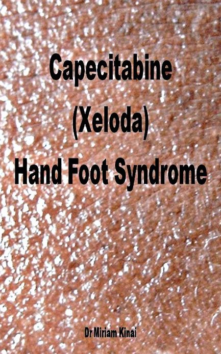 Capecitabine (Xeloda) Hand Foot Syndrome