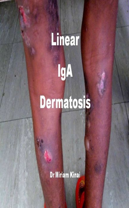 Linear IgA Dermatosis