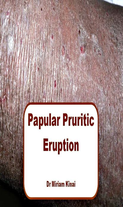 Papular Pruritic Eruption (PPE)