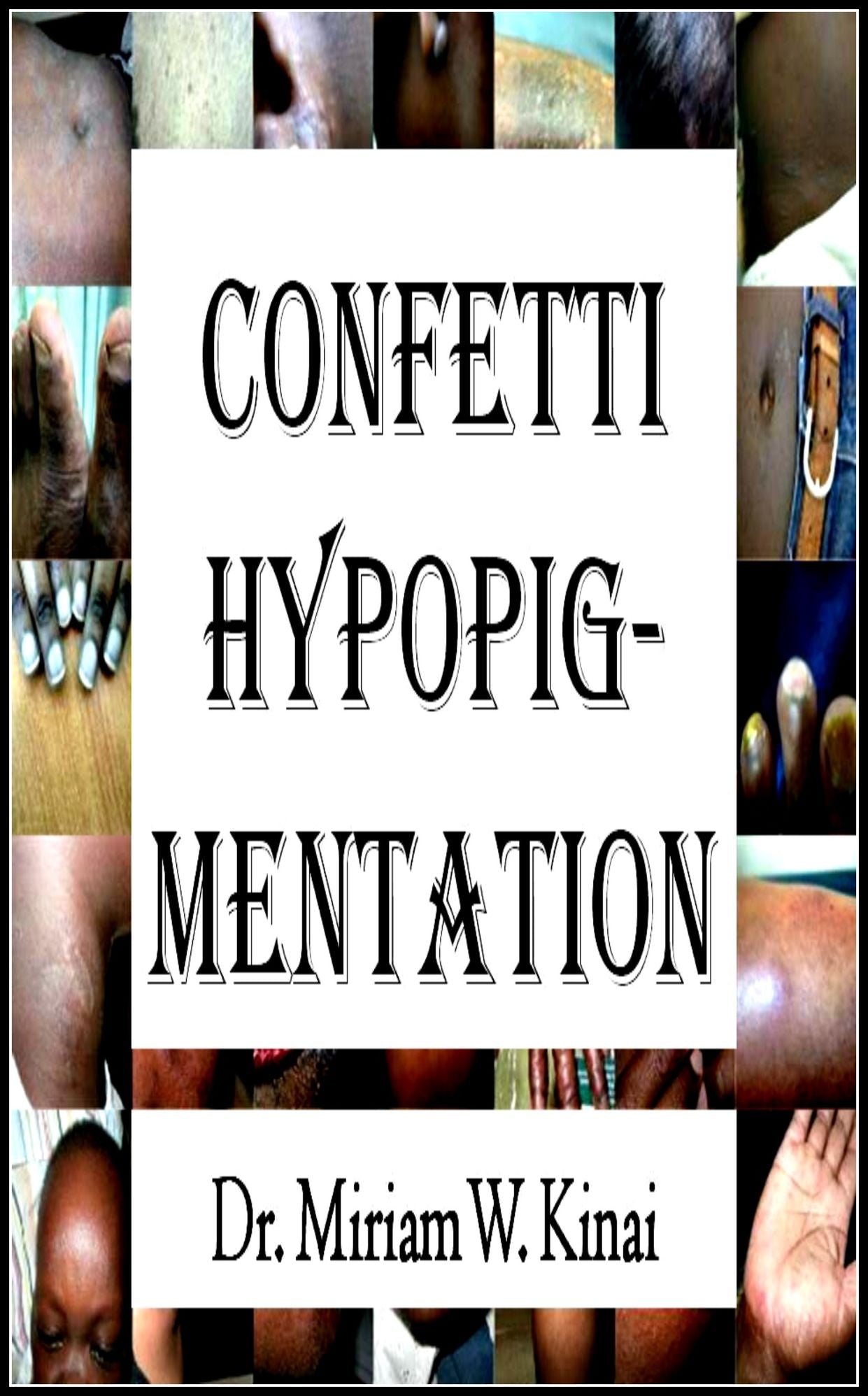 Confetti Hypopigmentation