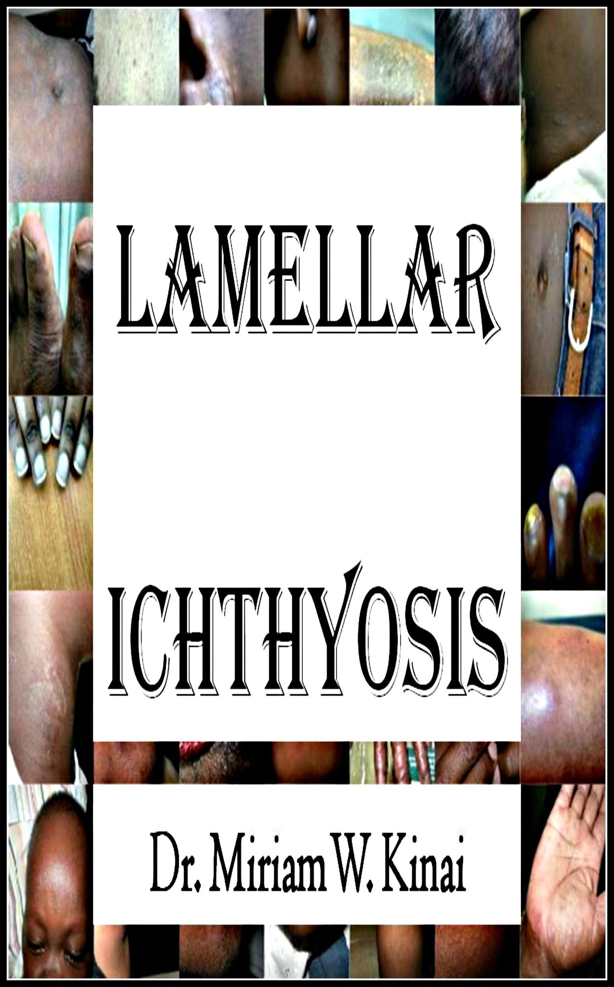 Lamellar Ichthyosis