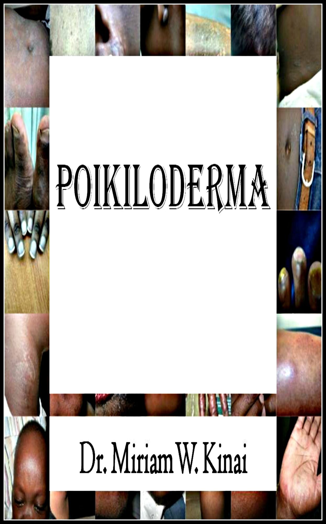 Poikiloderma