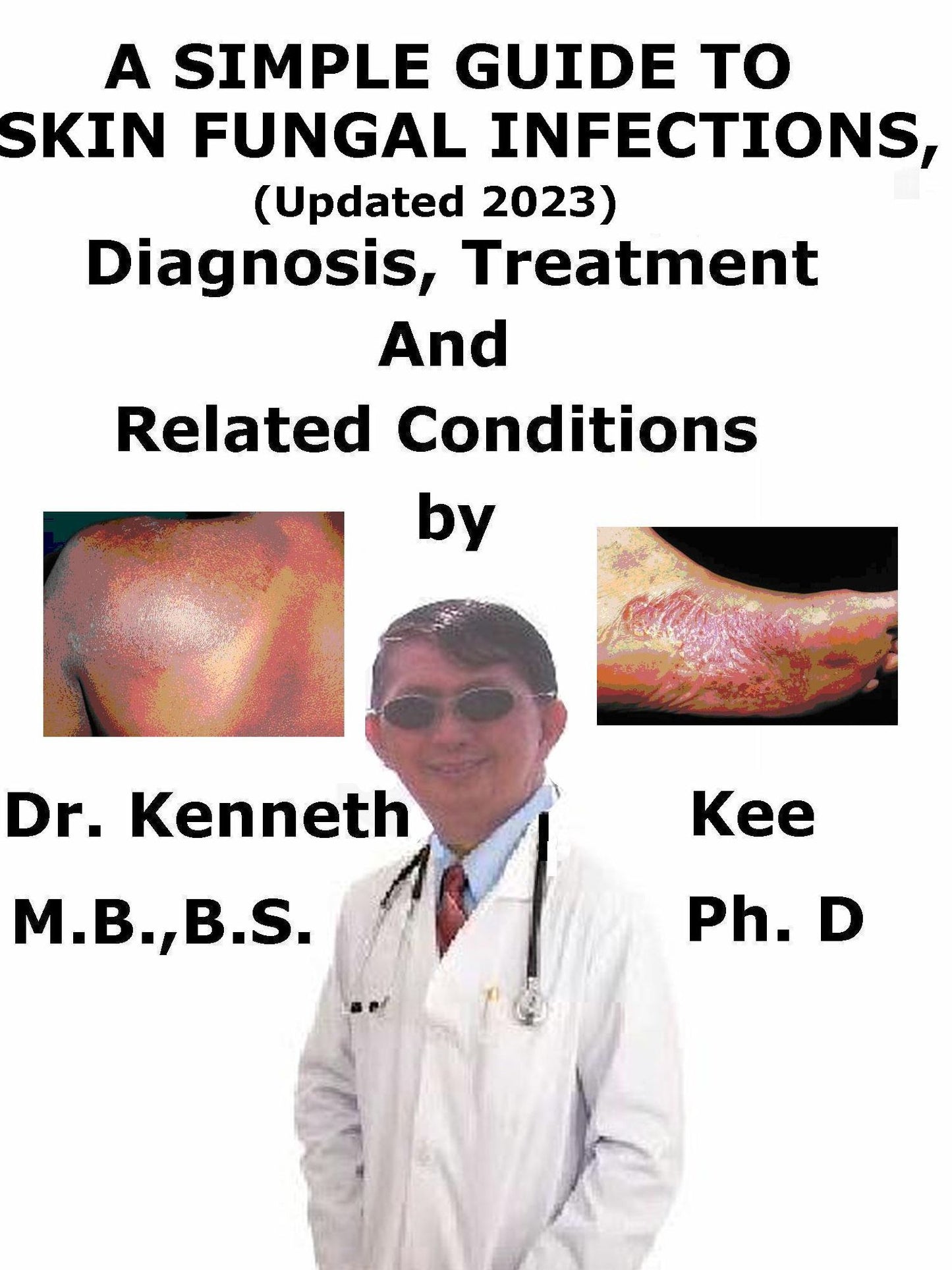 A Simple Guide to Skin Fungal Infections