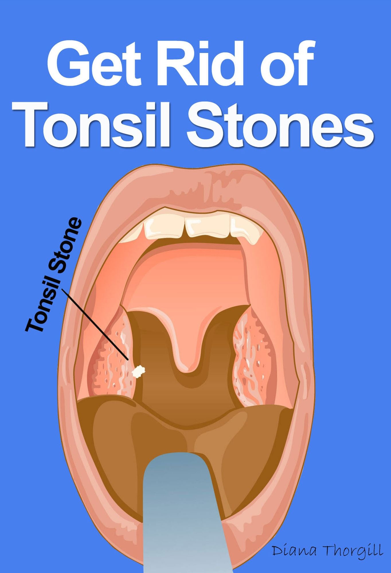 Get Rid of Tonsil Stones: Causes, Symptoms, Treatment, Removal and Other Remedies