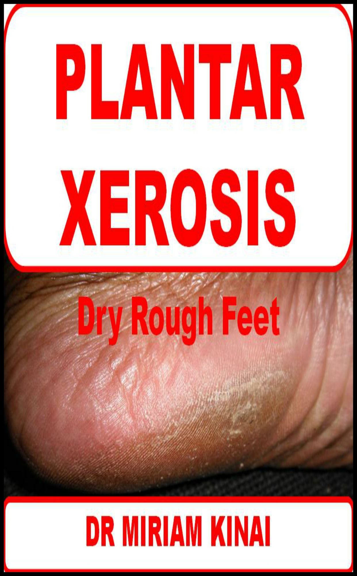 Plantar Xerosis