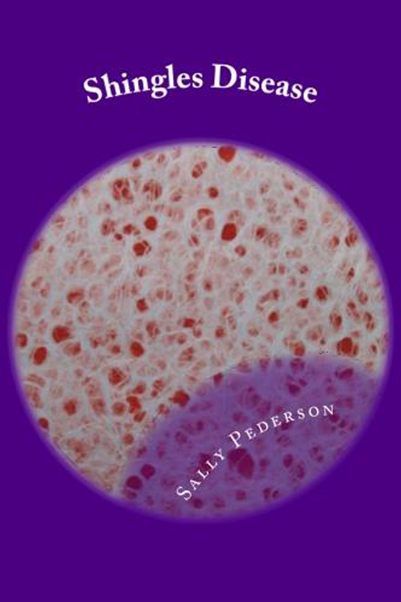 Shingles Disease: The Complete Guide