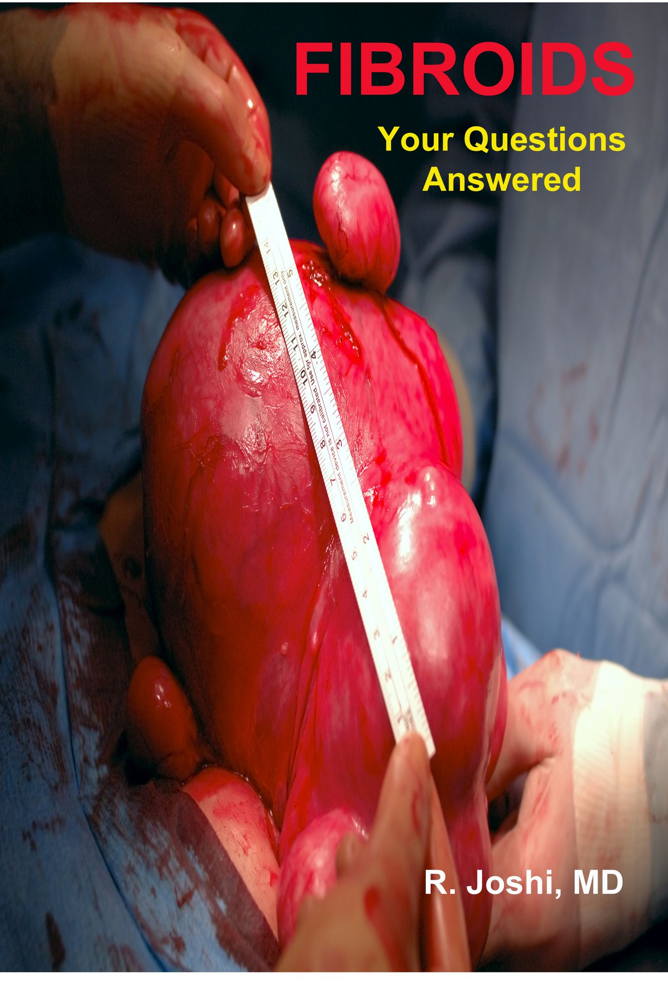 Fibroids: Your Questions Answered