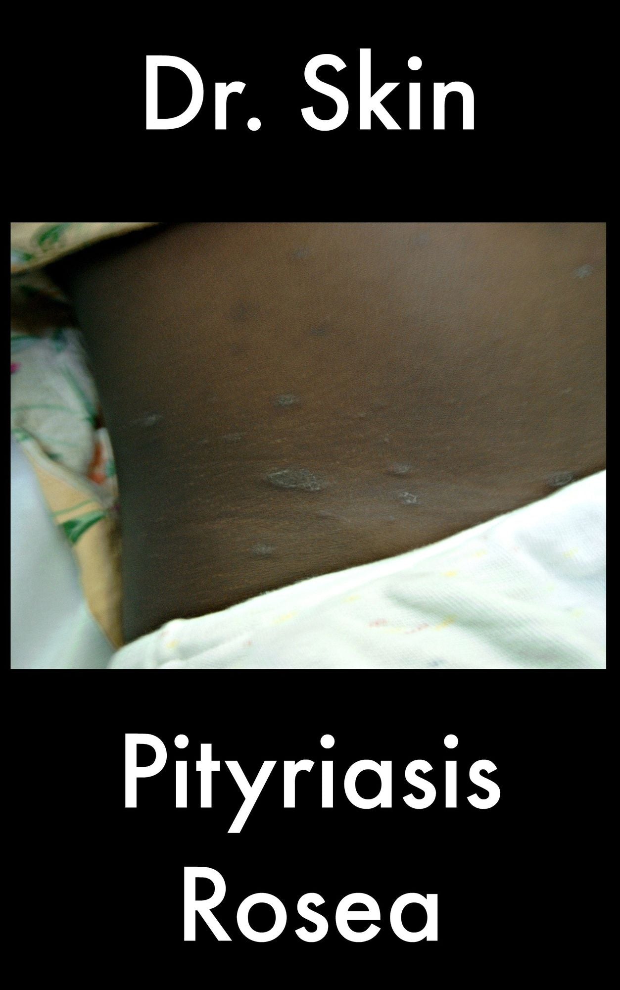 Pityriasis Rosea