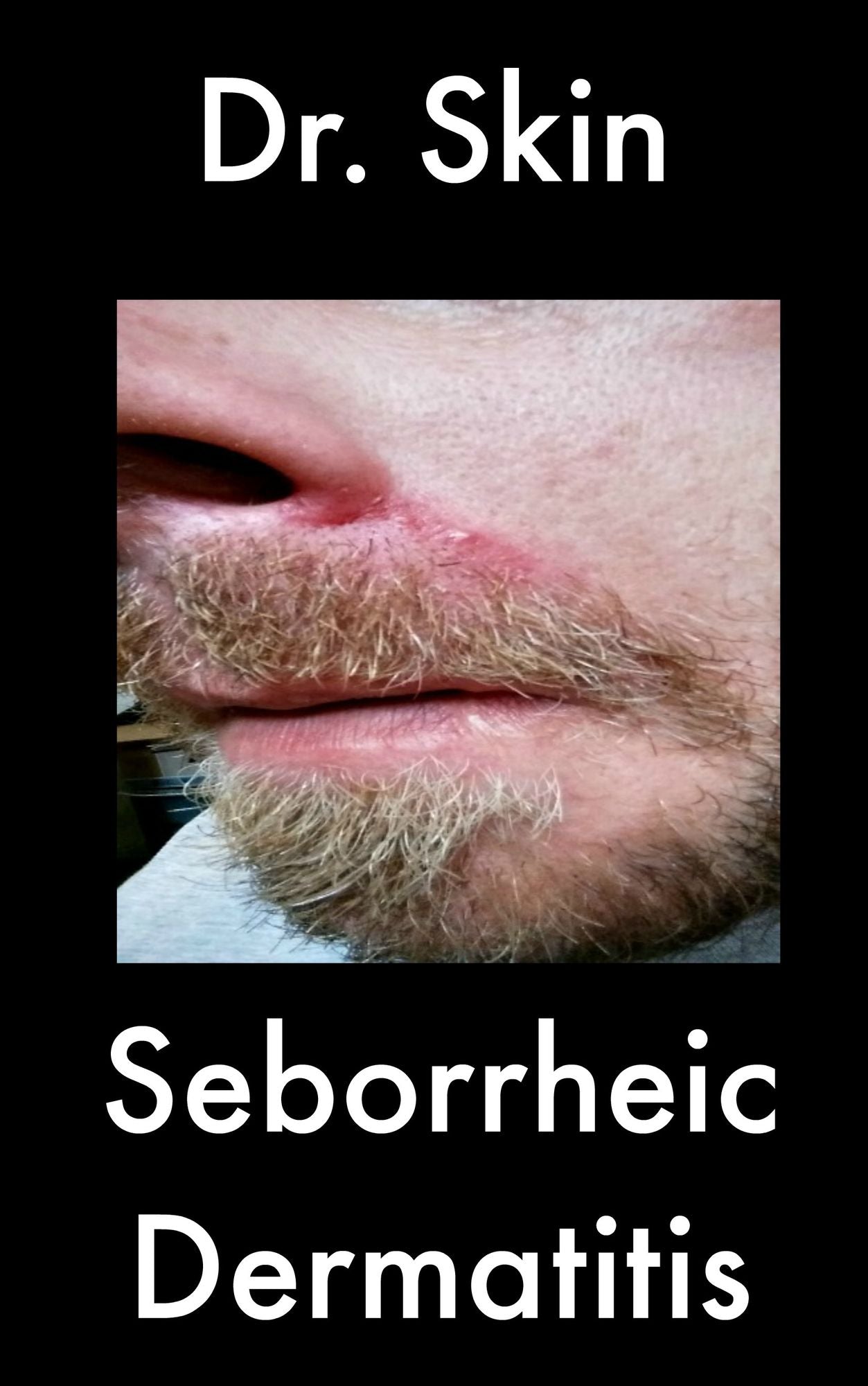 Seborrheic Dermatitis