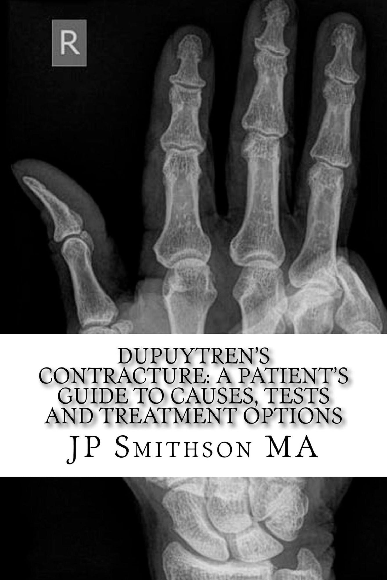 Dupuytren's Contracture: A Patient's Guide to Causes, Tests and Treatment Options