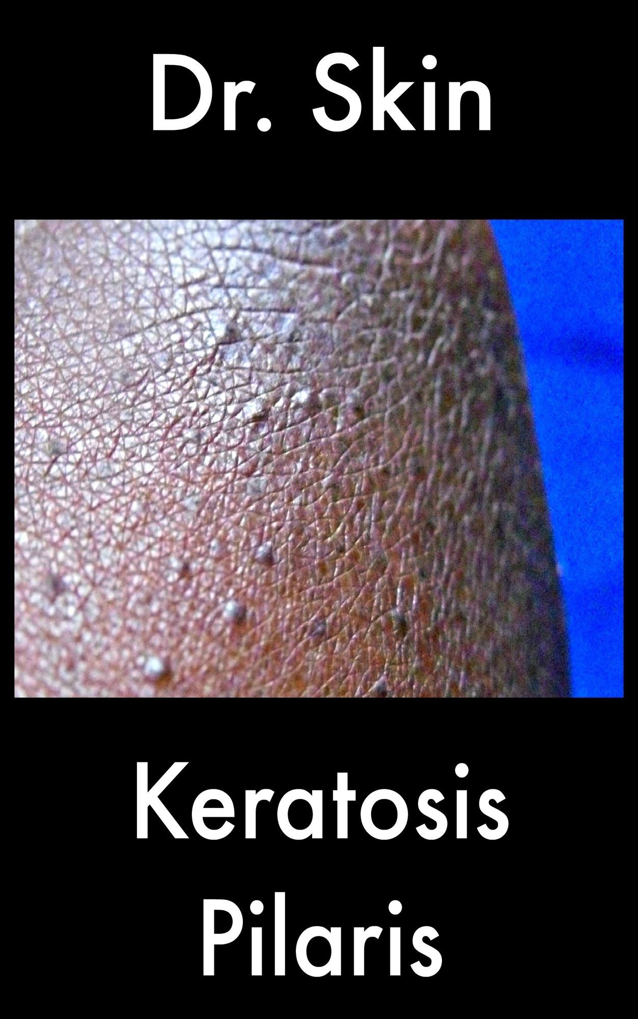 Keratosis Pilaris