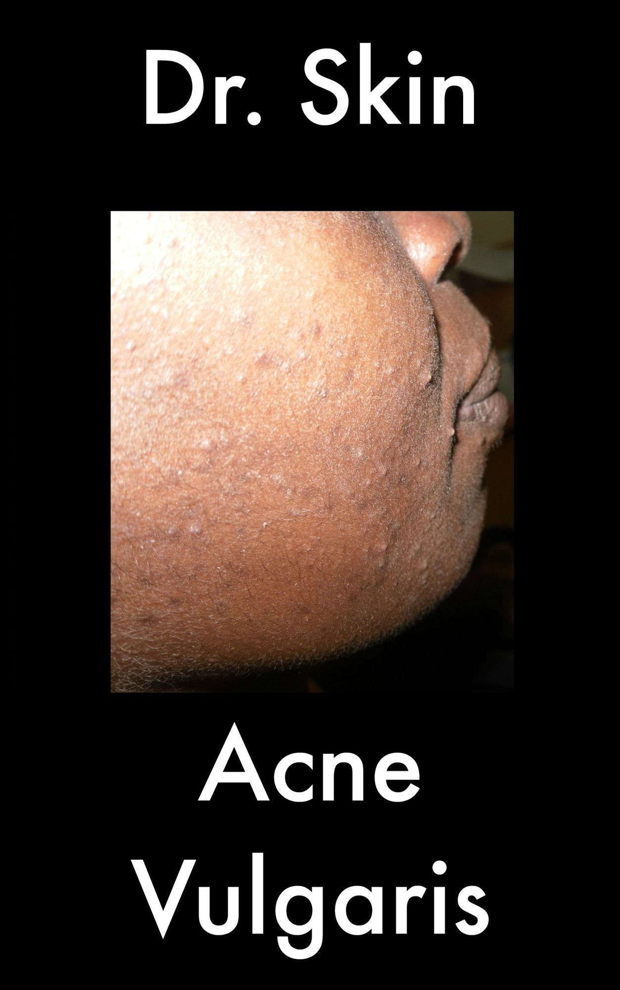 Acne Vulgaris