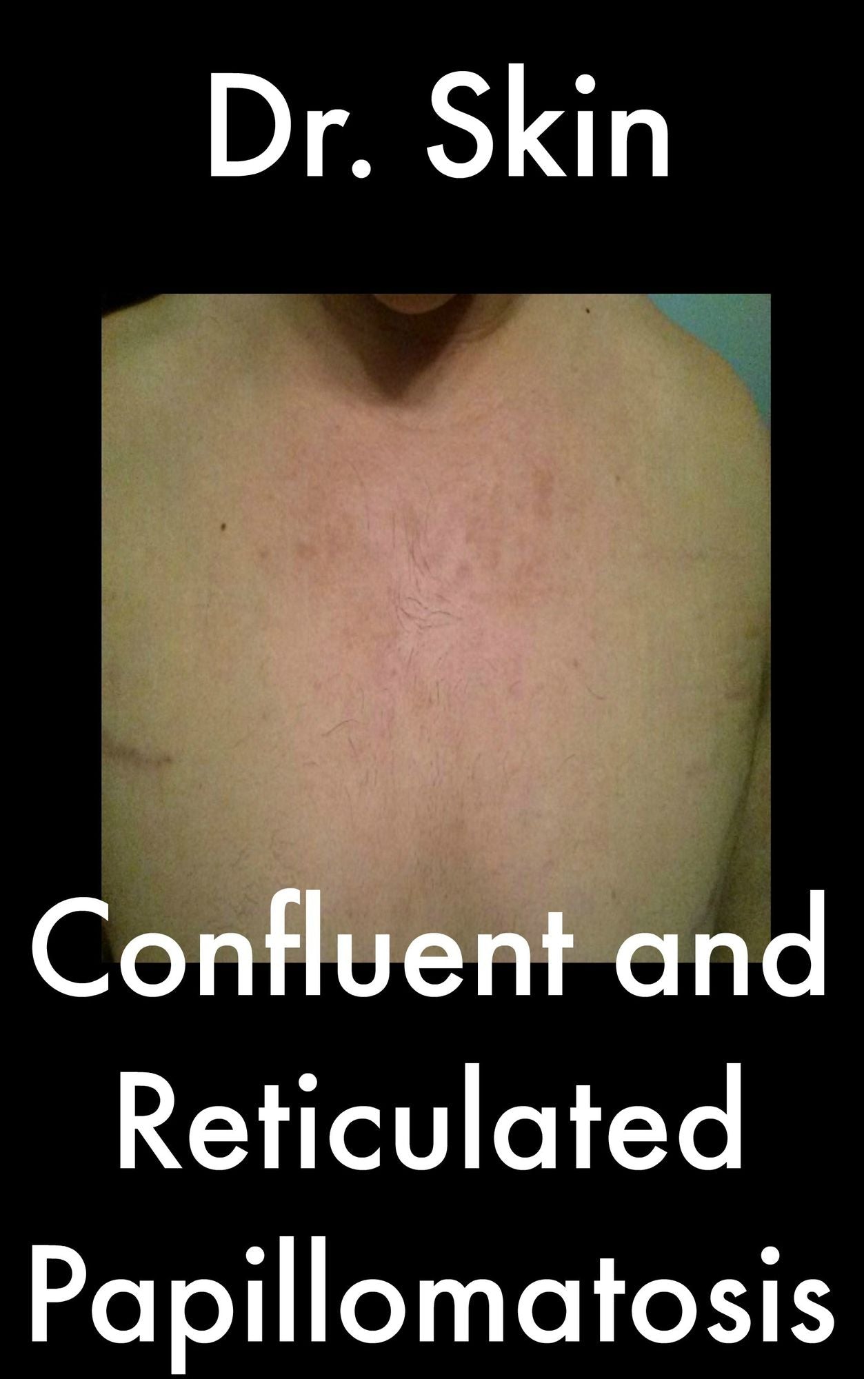 Confluent and Reticulated Papillomatosis