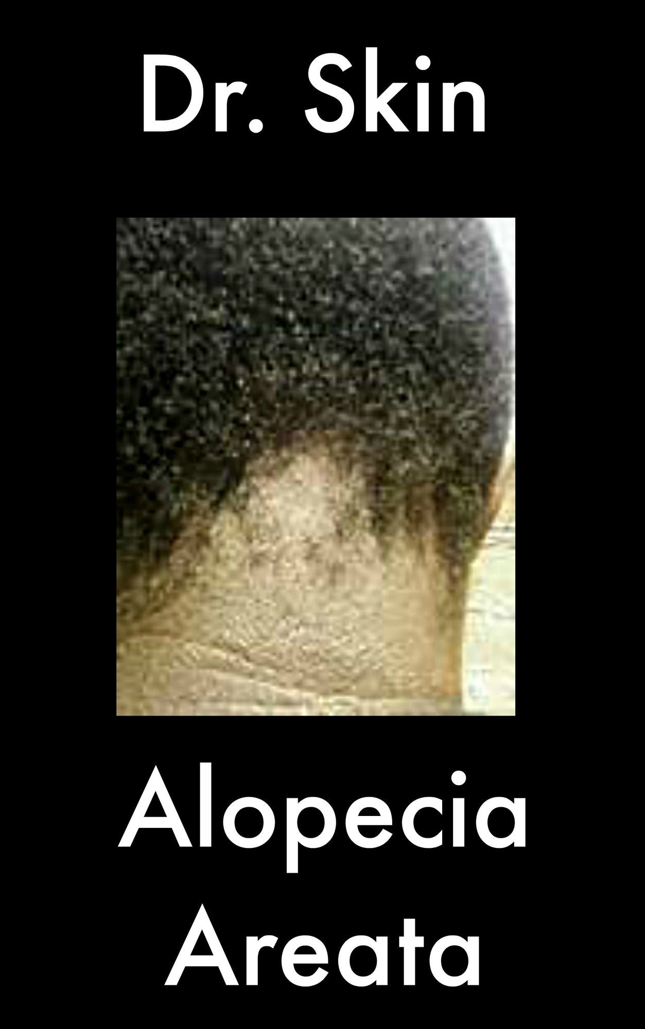 Alopecia Areata